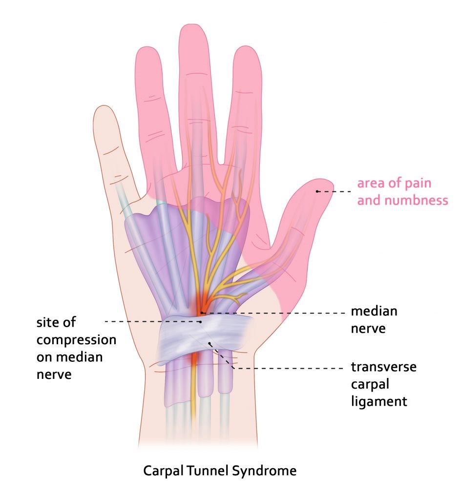 carpal tunnel syndrome, wrist pain, hand numbness, tingling hands, carpal tunnel relief, wrist brace, carpal tunnel symptoms, hand pain, nerve compression, carpal tunnel exercises, ergonomic support, carpal tunnel treatment, hand weakness, wrist surgery, repetitive strain injury, carpal tunnel prevention, hand therapy, workplace ergonomics, carpal tunnel doctor, Elite Wellness